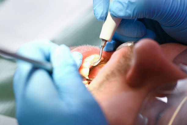 Best Emergency Tooth Extraction in Spring Lake, MI