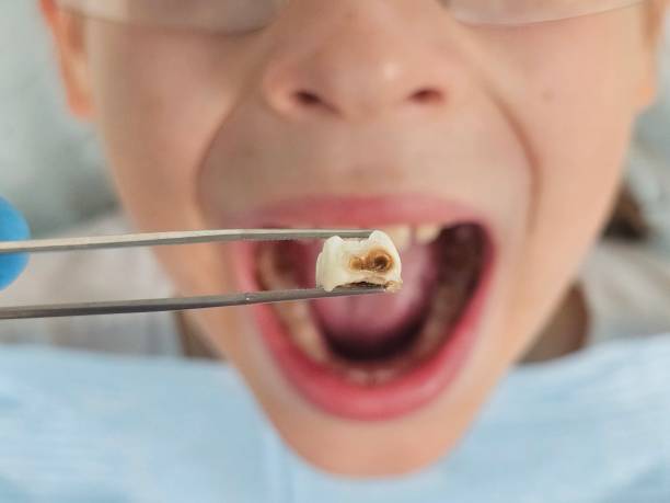 Best Emergency Tooth Extraction in Spring Lake, MI